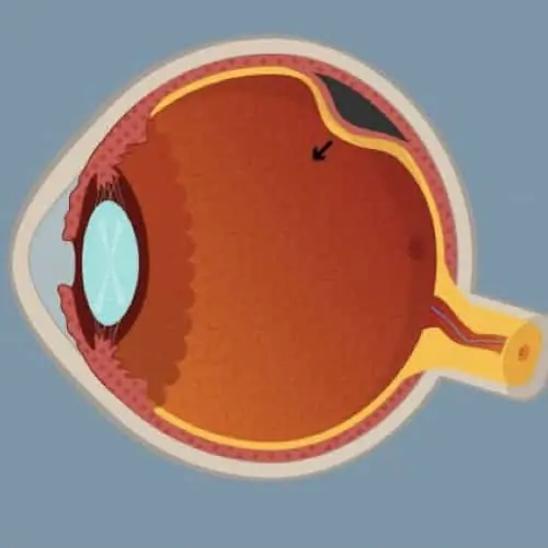 decollement retine symptomes decollement retine gaz decollement de retine cause maladies des yeux docteur nathalie butel ophtalmologiste paris 16 ophtalmologue paris 16