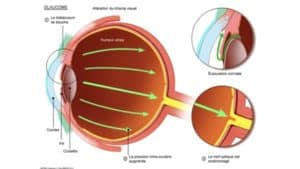 glaucome symptome le glaucome traitement un glaucome laser maladies des yeux docteur nathalie butel ophtalmologiste paris 16 ophtalmologue paris 16