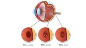 la dmla traitement injection dmla symptome dmla def dmla exsudative maladies des yeux docteur nathalie butel ophtalmologiste paris 16 ophtalmologue paris 16