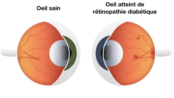 la retinopathie diabetique traitement retinopathie diabetique proliferante traitement maladies des yeux docteur nathalie butel ophtalmologiste paris 16 ophtalmologue paris 16