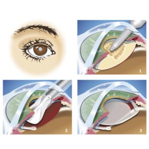operation cataracte paris chirurgie de la cataracte prix operation cataracte prix maladies des yeux docteur nathalie butel ophtalmologiste paris 16 ophtalmologue paris 16