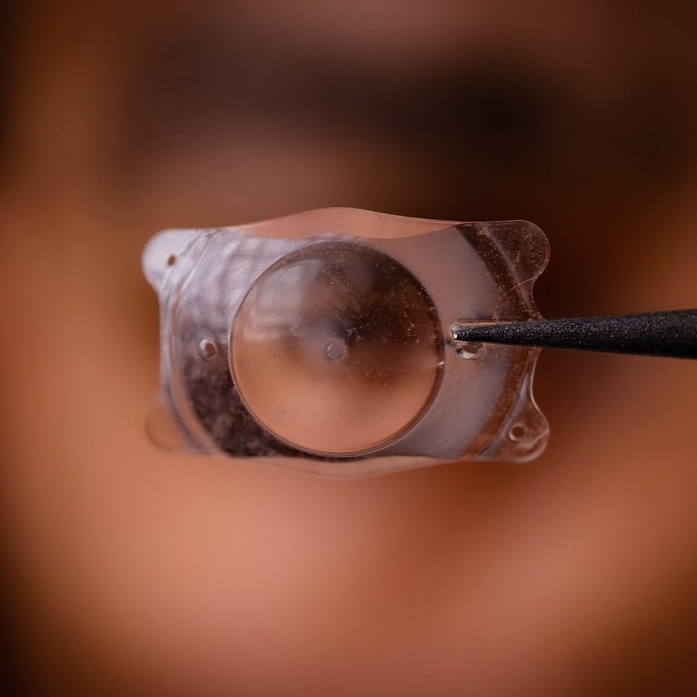 implant phake icl dr nathalie butel chirurgien ophtalmologue specialiste chirurgie refractive cataracte oculoplasticien paris implant phake icl dr nathalie butel chirurgien ophtalmologue specialiste chirurgie refractive cataracte oculoplasticien paris