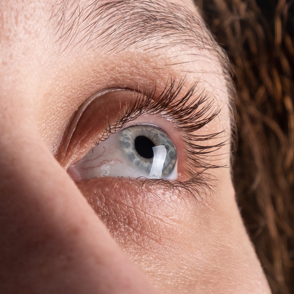 keratocone traitement dr nathalie butel chirurgien ophtalmologue specialiste chirurgie refractive cataracte oculoplastique paris