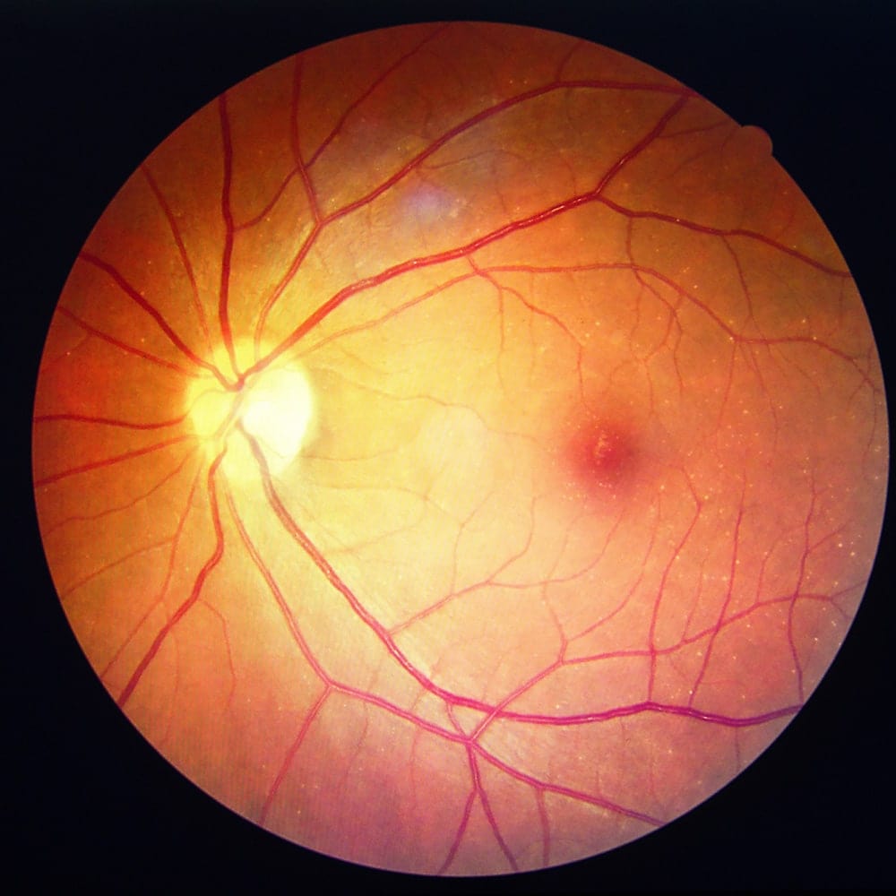 retinopathie diabetique traitement dr nathalie butel chirurgien ophtalmologue specialiste chirurgie refractive cataracte oculoplasticien paris retinopathie diabetique traitement dr nathalie butel chirurgien ophtalmologue specialiste chirurgie refractive cataracte oculoplasticien paris